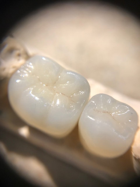 Pearlescent and life-like crowns for two teeth